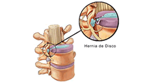 Ozonoterapia para Artrosis y lesiones musculares